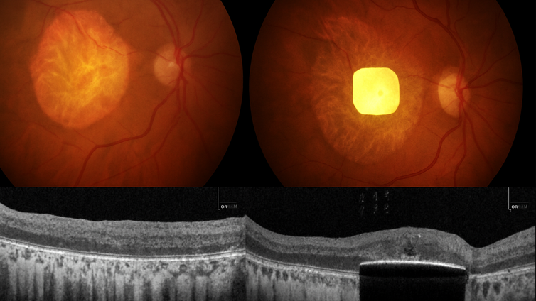 Immagine di Un impianto hi-tech fa leggere chi non vedeva più
