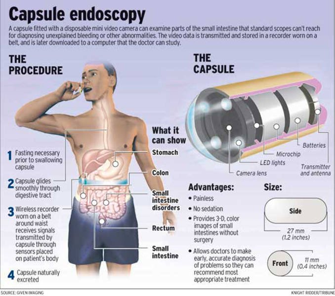 capsula-endoscopica-11293.jpg