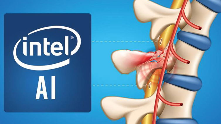 Immagine di Intelligenza artificiale Intel per aiutare i pazienti paralizzati a ritornare a muoversi