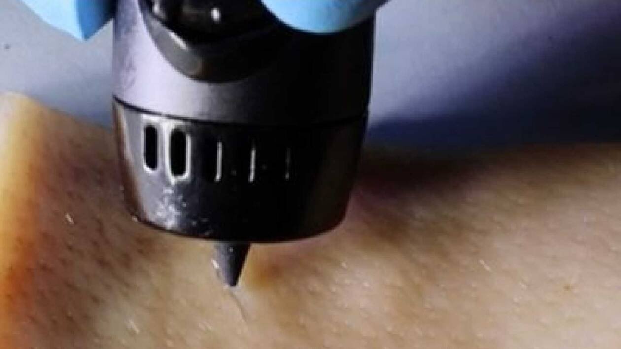 Immagine di Una stampante 3D portatile per sostituire bende e cerotti